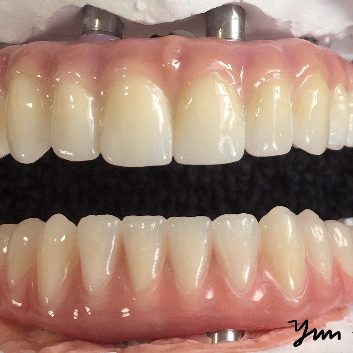 AllOn4 Hybrid Treatment WK Dental Ceramics