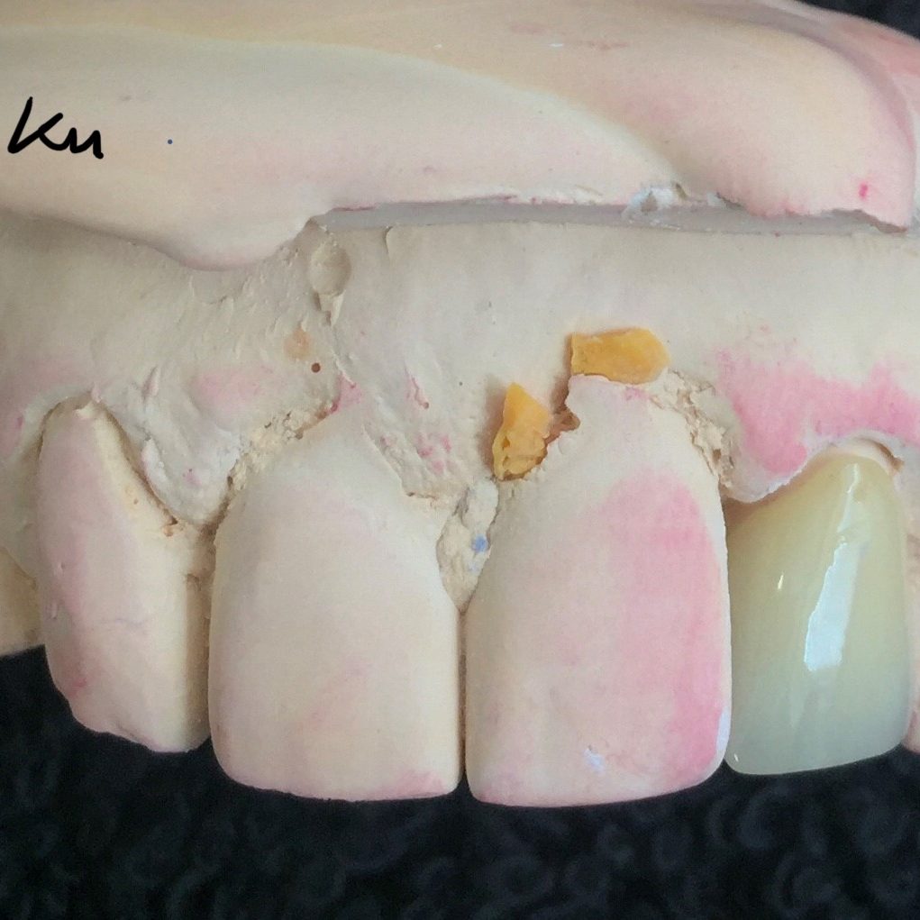 Crown & Bridge photo