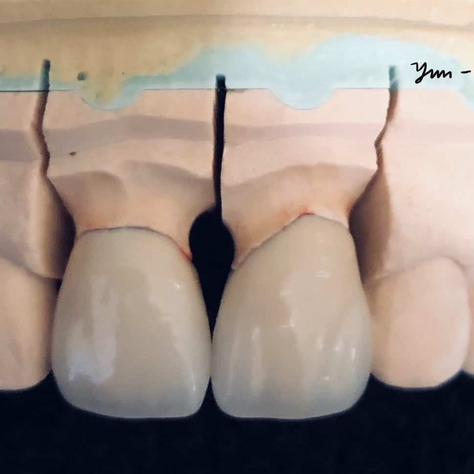 Crown & Bridge photo