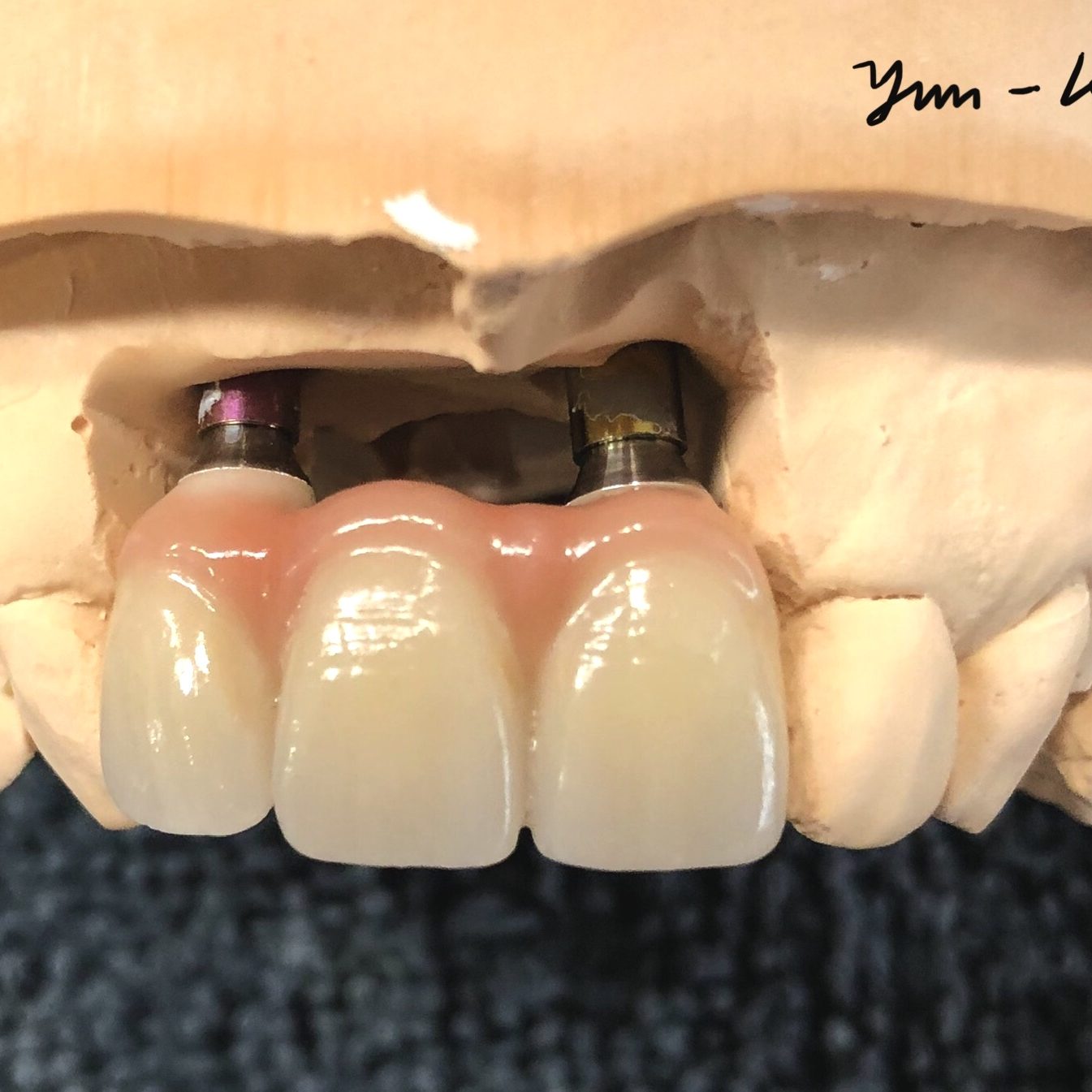 Dental implant photo