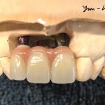 Dental implant photo