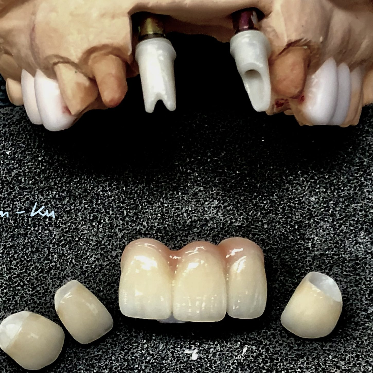 Dental implant photo