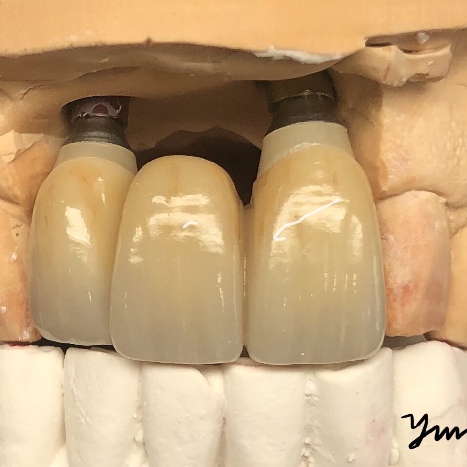 Dental implant photo