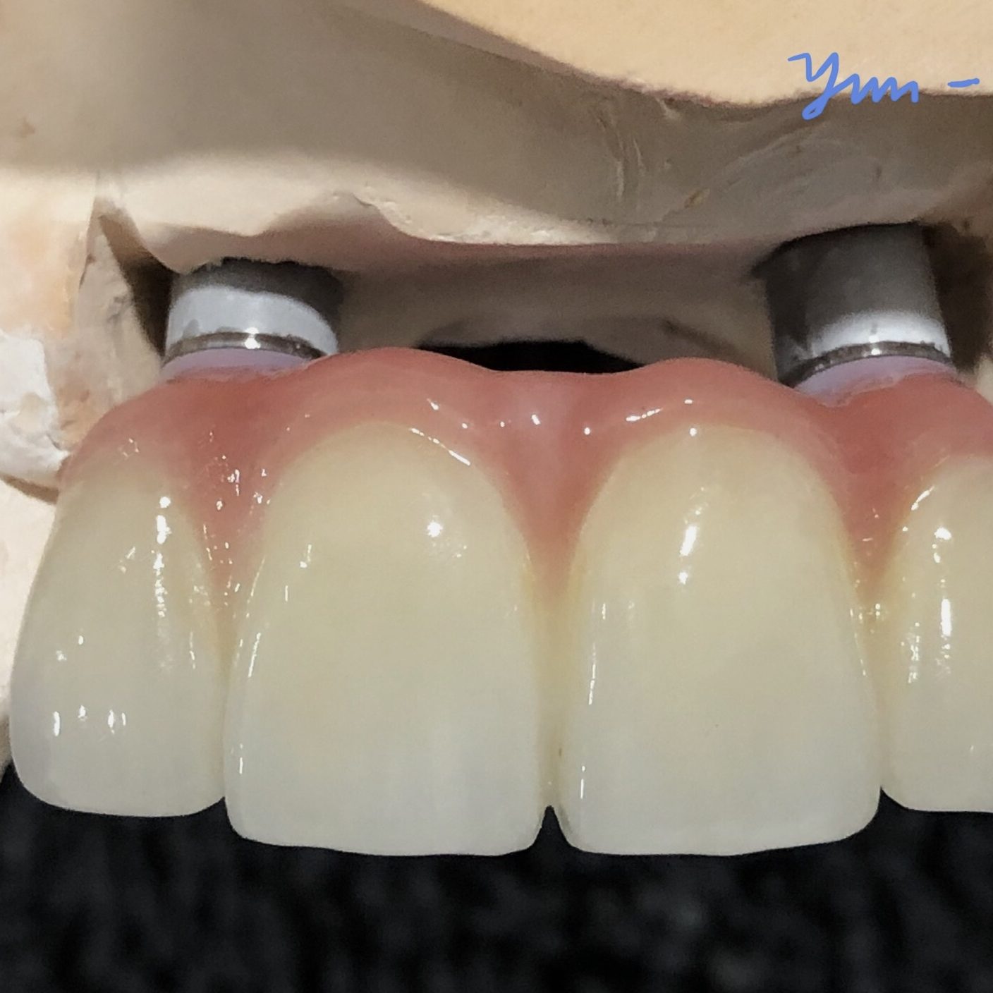 Dental implant photo
