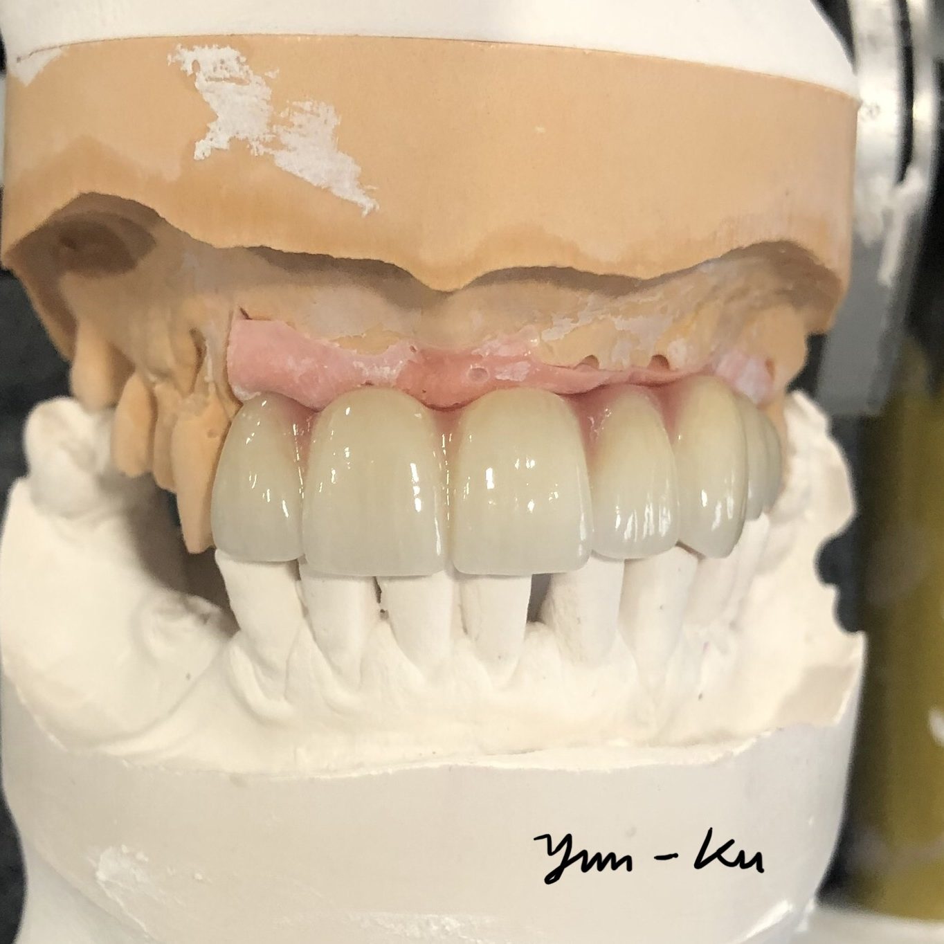 Dental implant photo