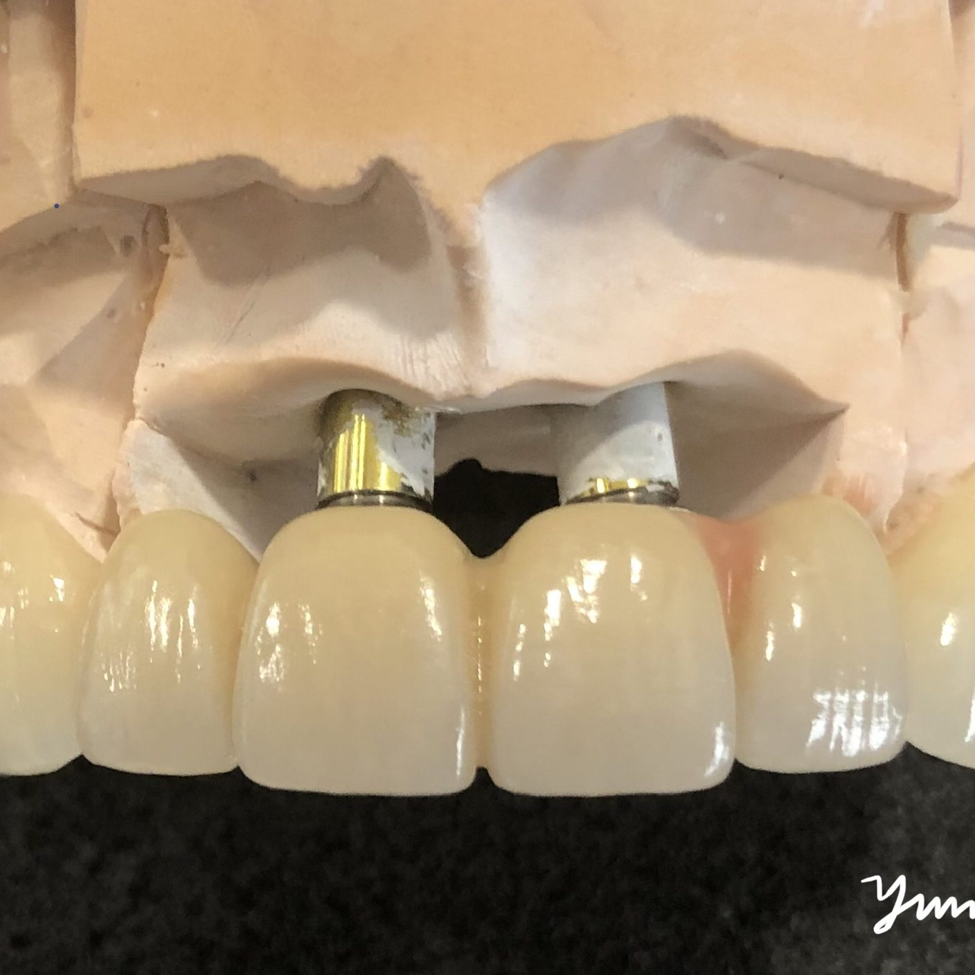 Dental implant photo