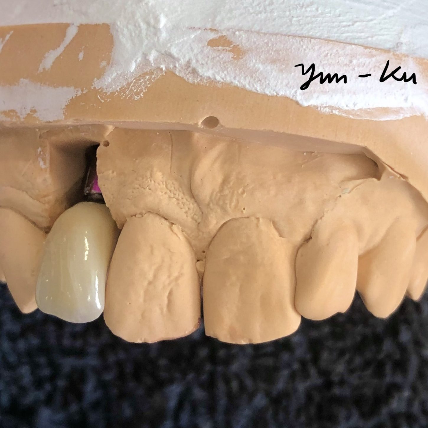 Dental implant photo