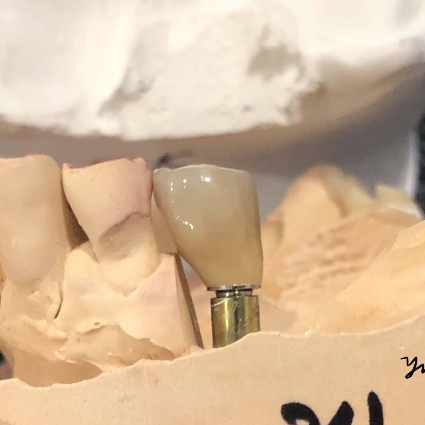 Dental implant photo