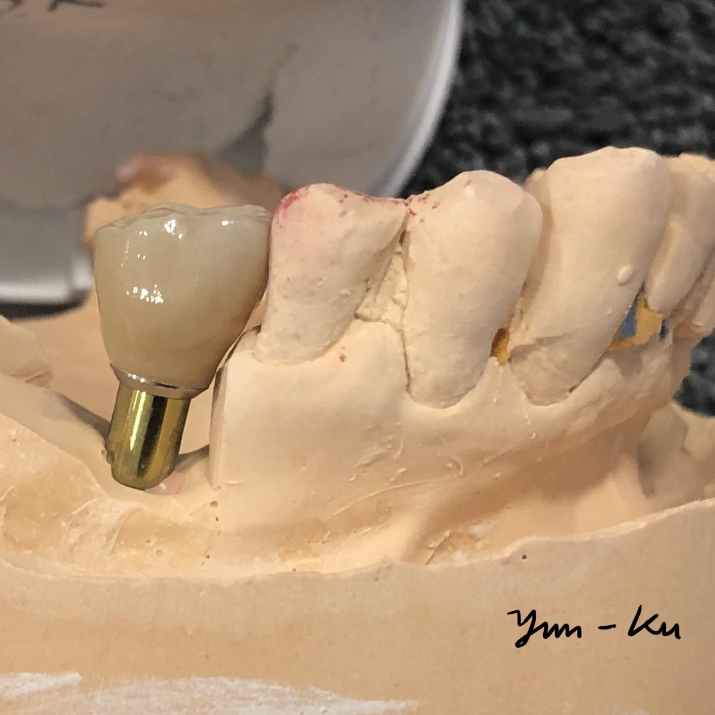 Dental implant photo