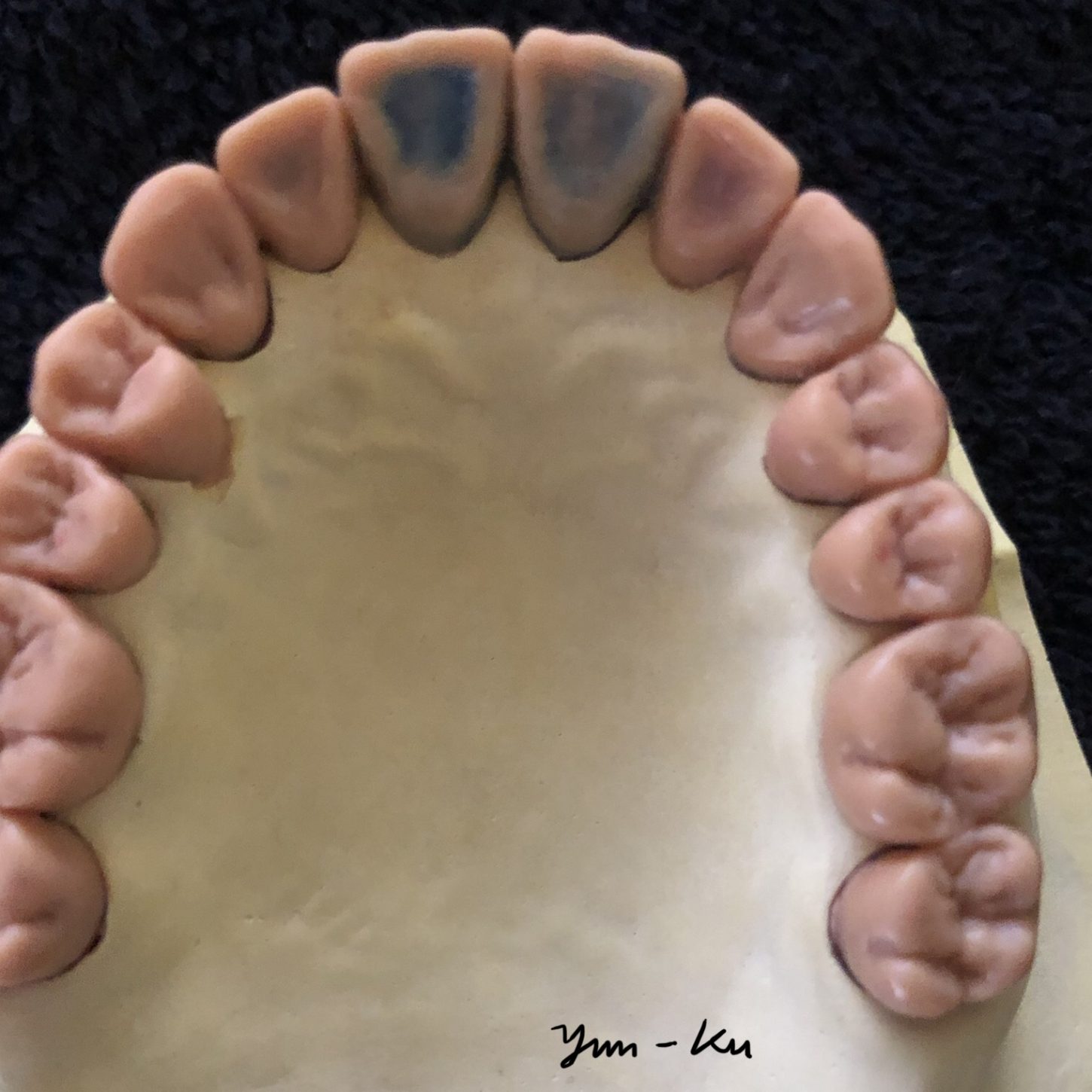 Diagnostic waxup 1-2