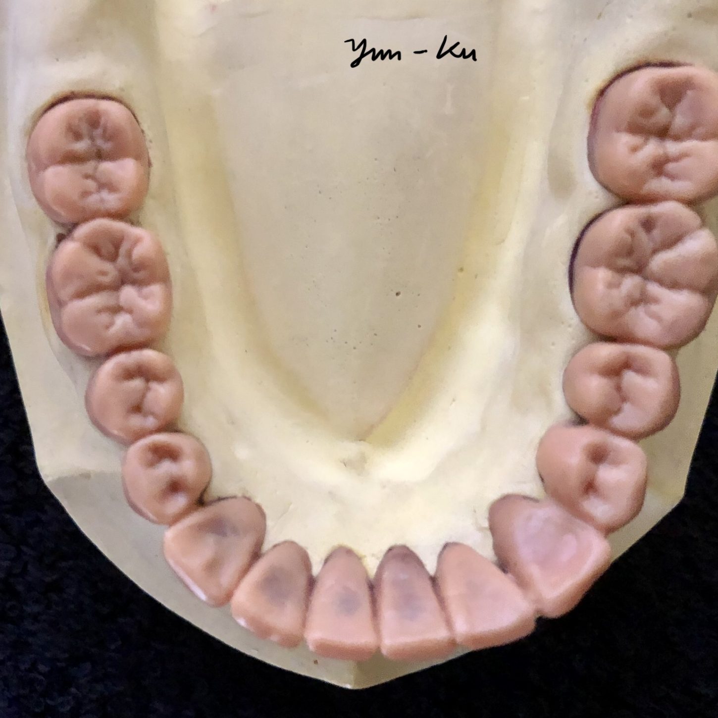 Diagnostic waxup 1-3